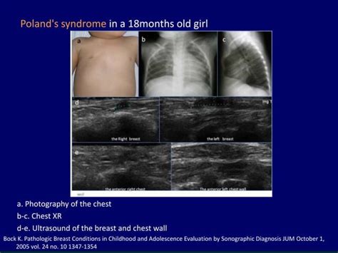 Pediatric and adolescent breast hypertrophy